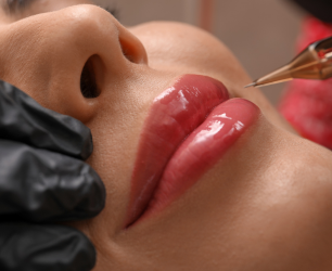 Fillers Treatment